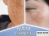 NÁM CHÂN SÂU - NÁM HỖN HỢP: VÌ SAO KHÓ TRỊ DỨT ĐIỄM?