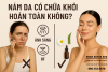 NÁM DA CÓ CHỮA KHỎI HOÀN TOÀN KHÔNG? CHUYÊN GIA PHAN DUYÊN SPA GIẢI ĐÁP