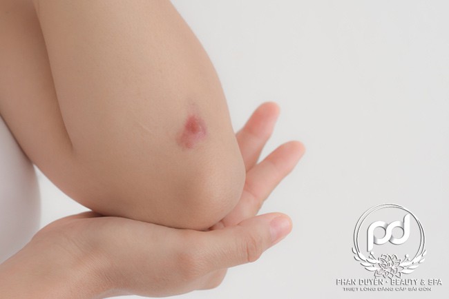 Trị sẹo bằng laser có an toàn, hiệu quả không?