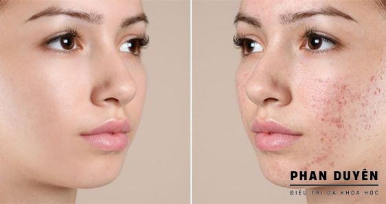 Đừng đổ lỗi cho nội tiết tố - Có những loại mụn do bạn đang tự gây ra!