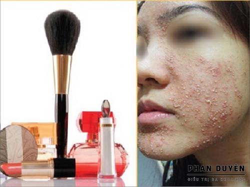 MỤN NỘI TIẾT KHÁCH GÌ MỤN DO MỸ PHẨM? CÁCH TRỊ KHÁCH NHAU RA SAO?