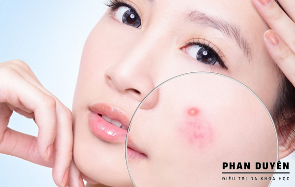 TỰ NẶN MỤN TẠI NHÀ: TÀN NHANG, THÂM, SẸO SẼ RỦ NHAU TỚI THĂM BẠN.