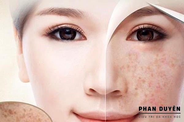 Điều trị da nám - Đừng nghe quảng cáo trị nám 7 ngày - Nám là bệnh lý mãn tính cần chiến lược lâu dài!