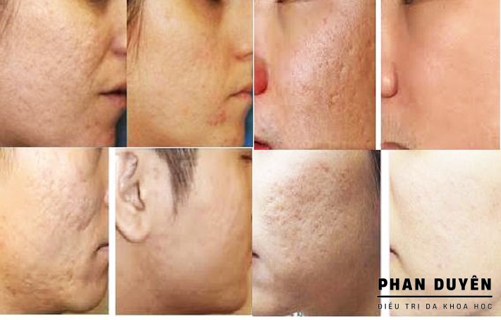ĐIỀU TRỊ SẸO CHUYÊN NGHIỆP VÀ KHOA HỌC TẠI PHAN DUYÊN SPA