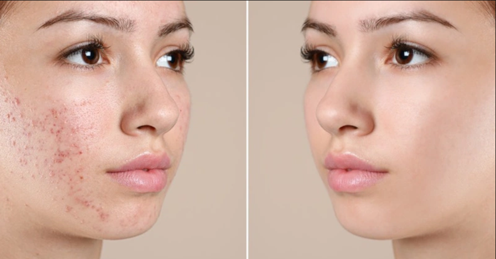 Phục hồi da mụn