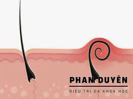 LÔNG MỌC NGƯỢC, VIÊM NANG LÔNG SAU CẠO - CÁCH XỬ LÝ VÀ PHÒNG NGỪA.