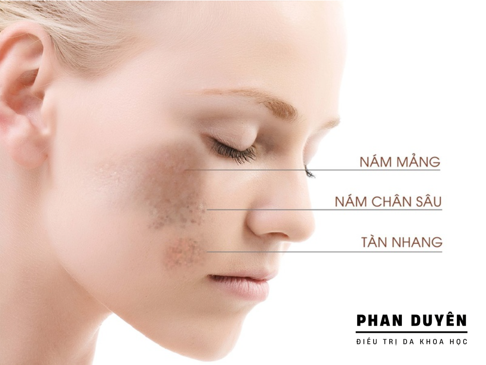 Tại Sao Lột – Tẩy – Lăn Kim “Vô Tội Vạ” Lại Gây Hại Cho Da Nám?