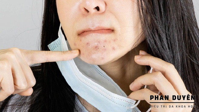 mụn do đeo khẩu trang