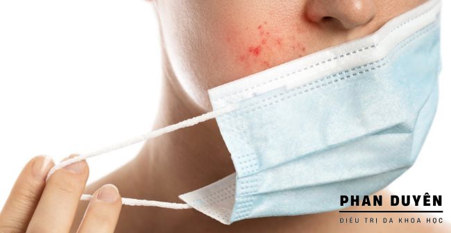 Mụn Do Khẩu Trang, Nắng Nóng, Mùa Hè Tăng Tiết Dầu – Đánh Bay Mụn Cùng PHAN DUYÊN SPA!