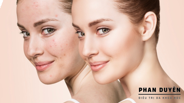 Phục hồi Da Mụn tại Phan Duyên
