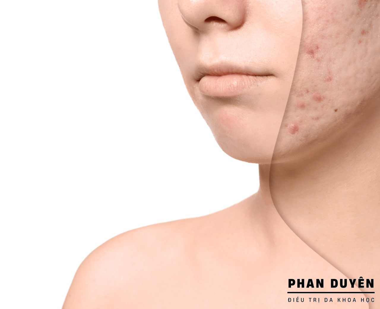 ĐIỀU TRỊ DA SẸO , RỔ TẠI PHAN DUYÊN SPA - ĐIỀU TRỊ DA KHOA HỌC