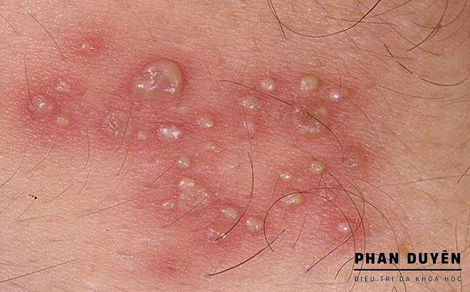 tinh trang viem nang long