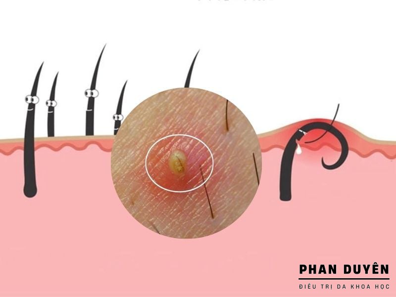vung kin co u nang long khi long moc nguoc